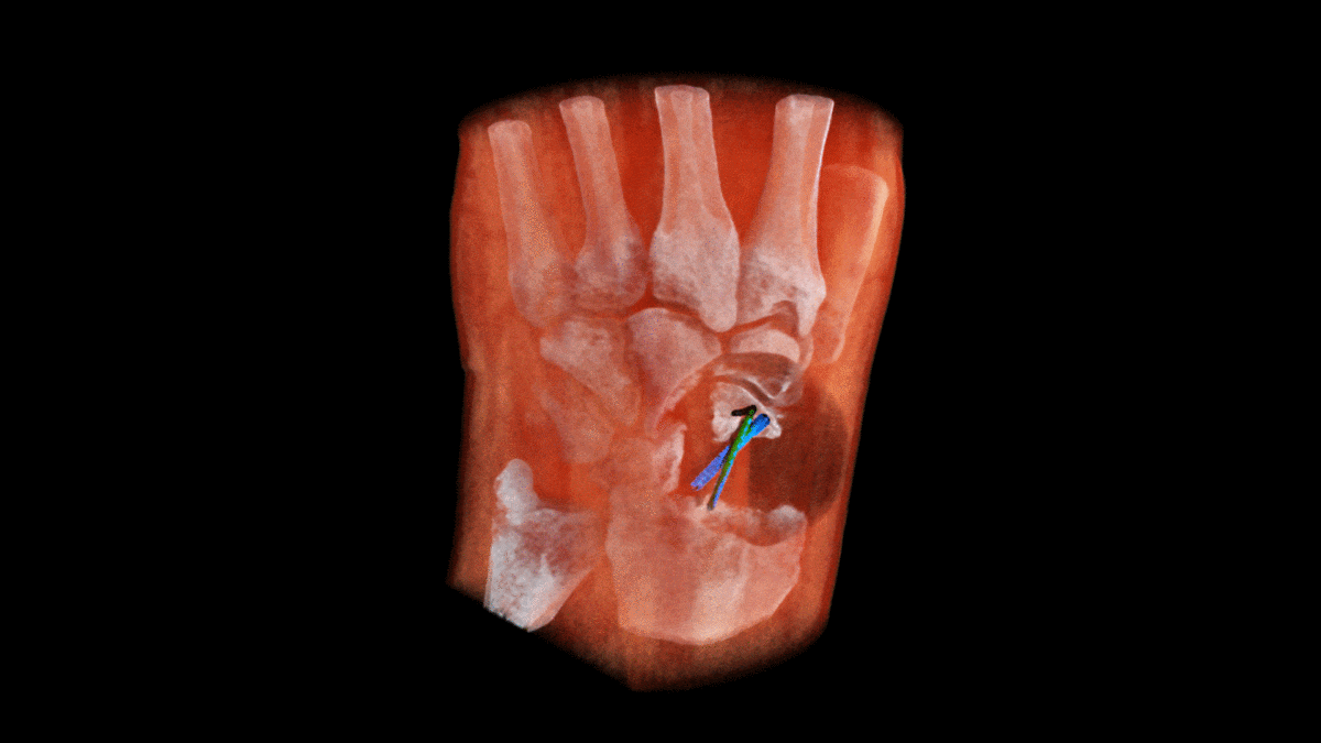New 3D colour wrist X-ray made possible by the MARS Bioimaging scanner, showing a metallic screw (blue) and K-wire (green). (Image: MARS Bioimaging)