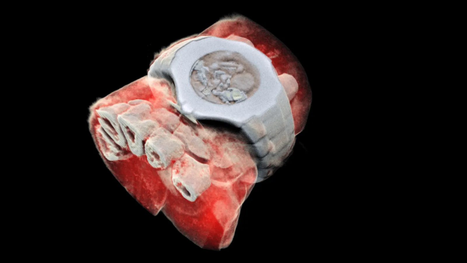 First 3D colour X-ray of a human using CERN technology
